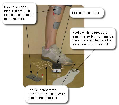 Functional Electrical Stimulation or FES uses electrical impulses to stimulate muscle contraction and assist in walking.